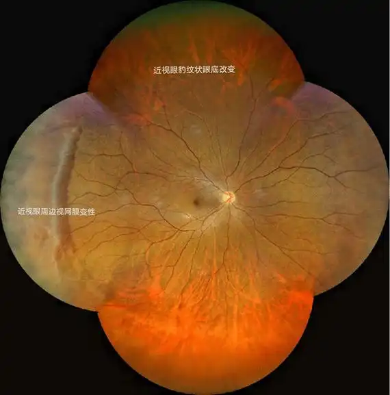 院长常学斌表示:蔡司 clarus 500无需散瞳剂就能进行视网膜图像分析