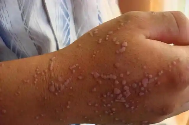 当感染了hpv后皮肤上可能会出现这些症状若发现请及时就医