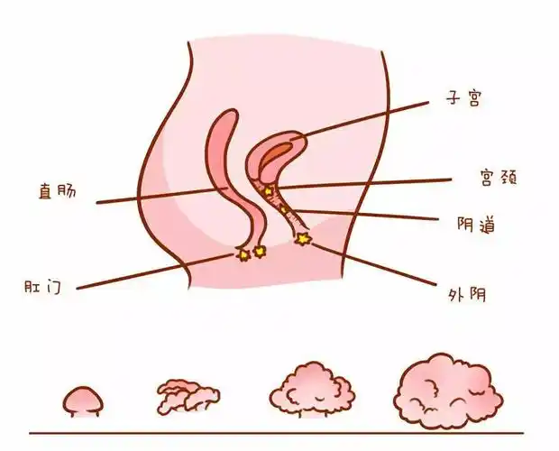 女性尖锐湿疣症状