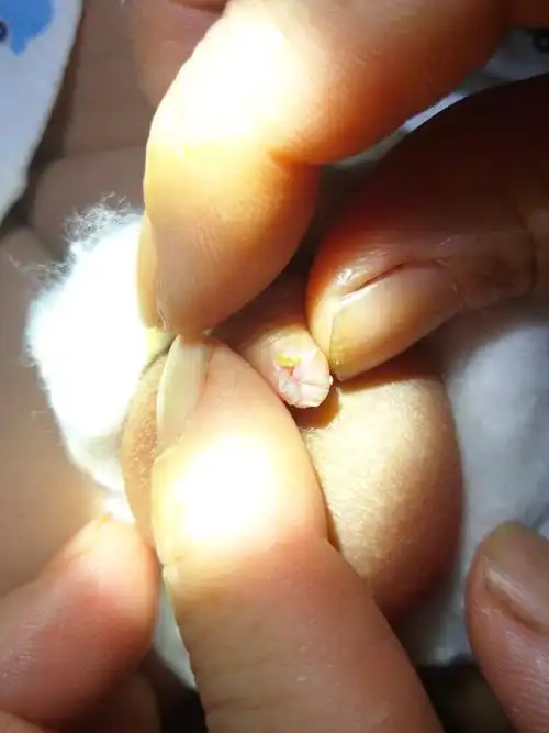 是尿道不正常吗?