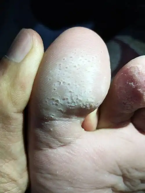 脚底长了这么多小洞洞,不疼也不痒.这是什么