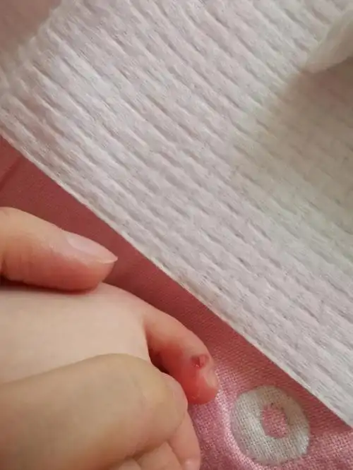 477天1521第一次受伤流血