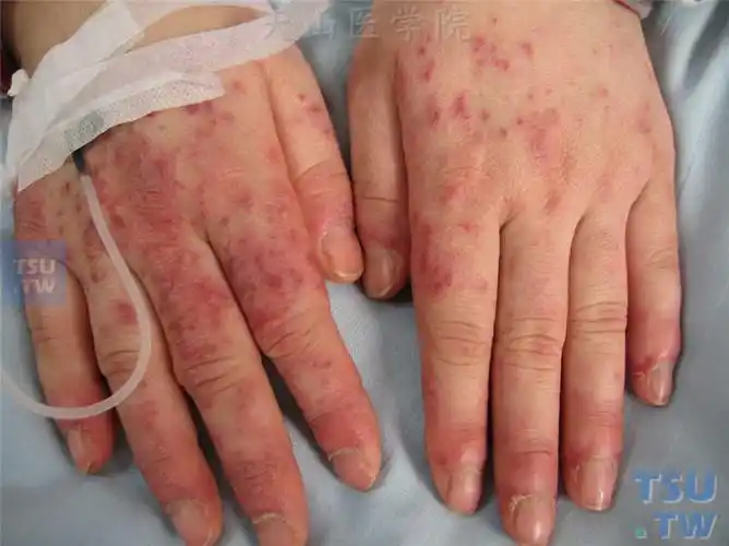 系统性红斑狼疮(sle)的症状表现