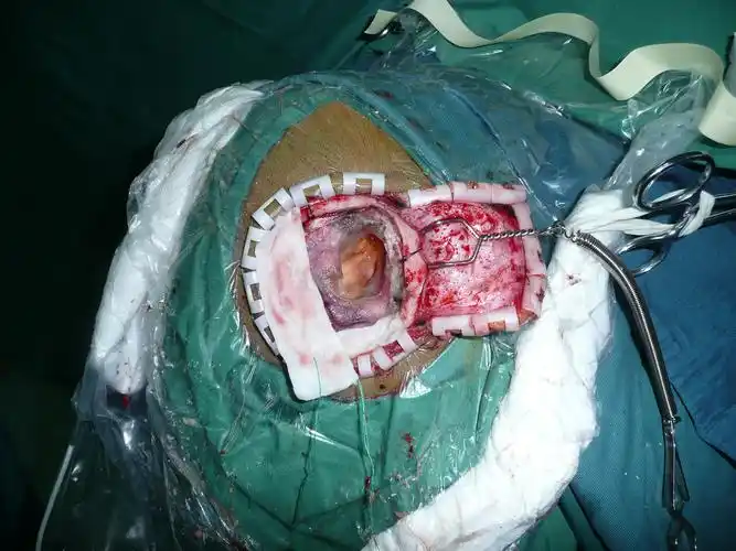 非常见颅内蛛网膜囊肿微创开颅手术治疗