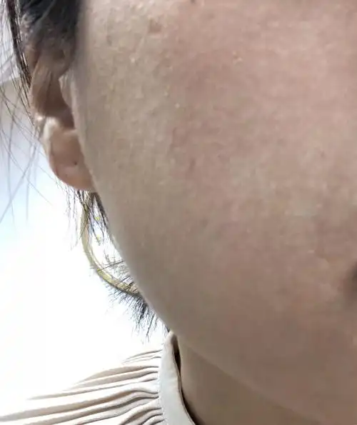 去了青岛,第一天没事,第二天脸颊有点痒,第三天眼部就出现干纹脸色偏