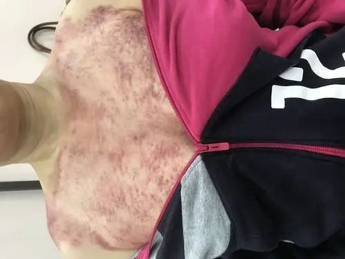 抽动症刮痧方案 - 简书