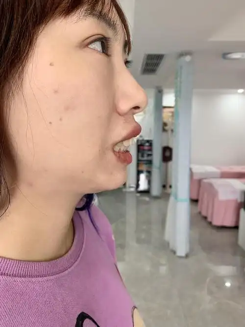 问大家姐们们我的牙还有救吗01骨性前突77牙缝大