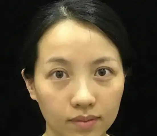 30岁后想抗衰老,建议选这几种医美项目,别再盲目做没用功