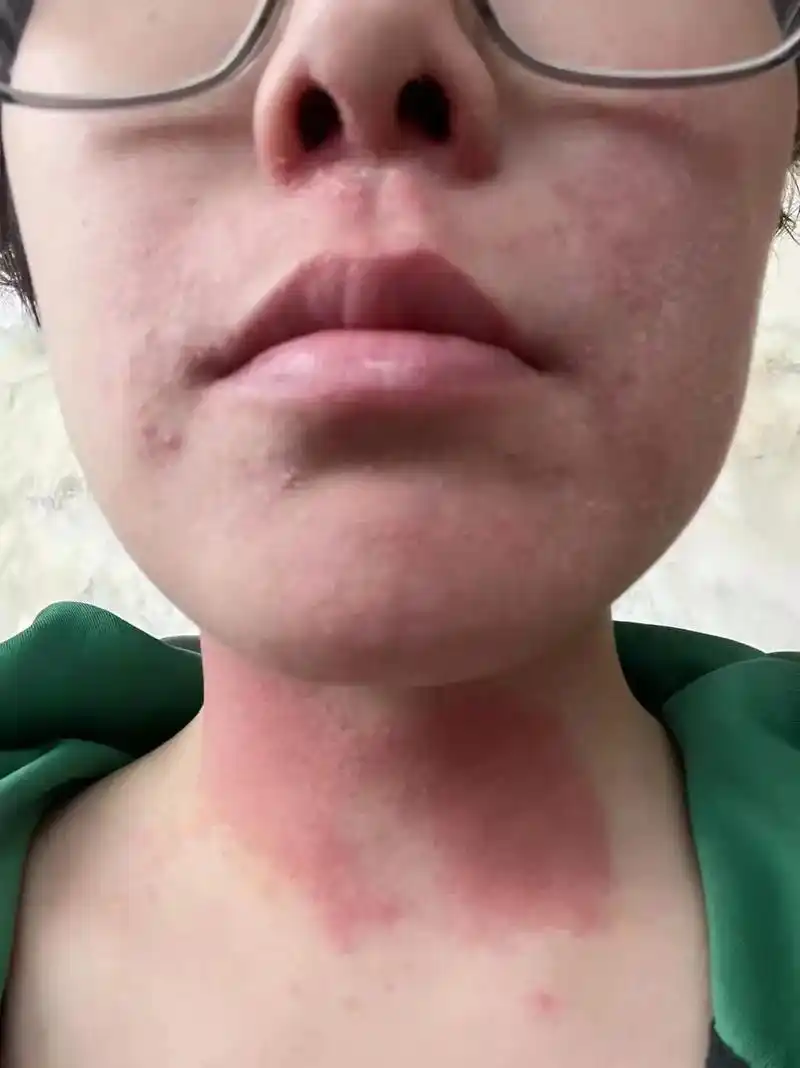 红肿过敏痒激素脸美颜油三年解决