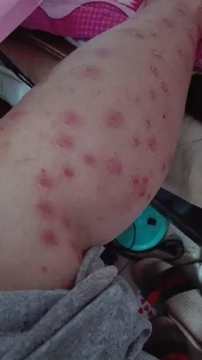 汗斑癣什么症状