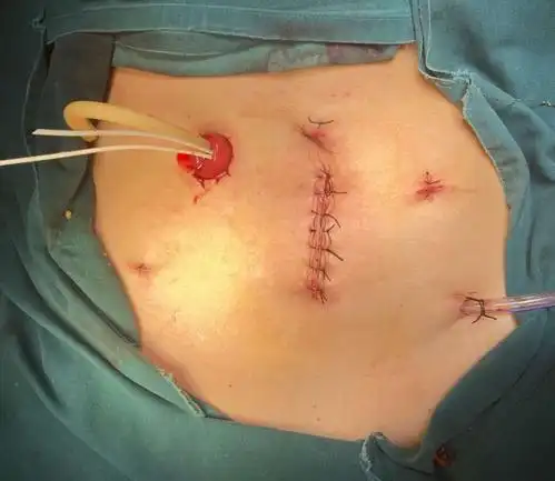 再增一例18种重点手术,腹腔镜下女性膀胱癌根治,回肠膀胱 子宫,卵巢全