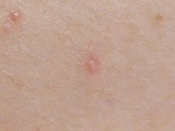 指的是人乳头瘤病毒,人们在感染hpv病毒之后身体容易出现各种皮肤及