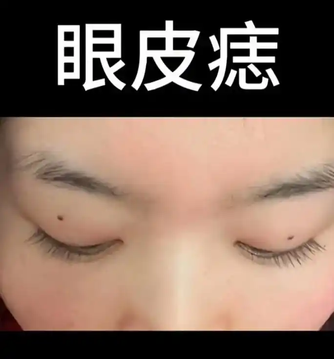 在面相学中,眼皮上长痣的人聪明,容易掌握特殊才能,胳膊容易受 - 抖音