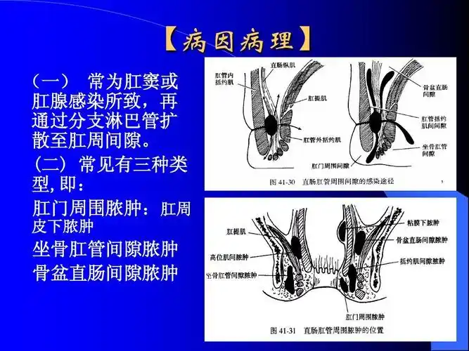 坐骨肛管间隙脓肿 骨盆直肠间隙脓肿