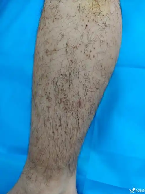 请教:小腿泛发褐色斑疹3年