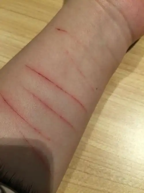 用刀割伤,用什么不能留疤痕,我不是疤痕体质,谁有