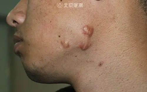 瘢痕疙瘩为什么被称为世界医学难题