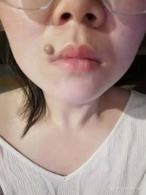手术切痣来啦嘴角的痣