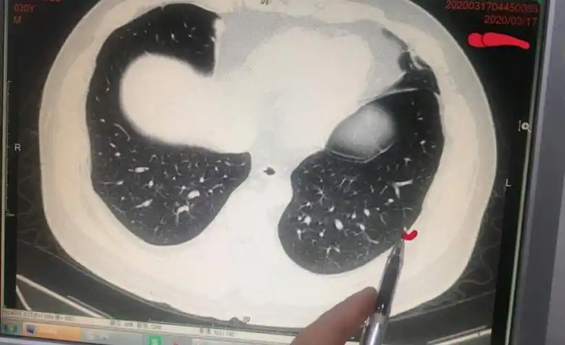 刘懿博士说肺癌一八六一4年的2mm肺结节是纤维灶还是淋巴结