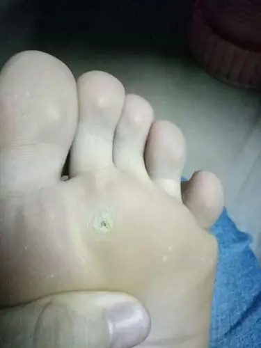 脚底这个洞是什么情况?