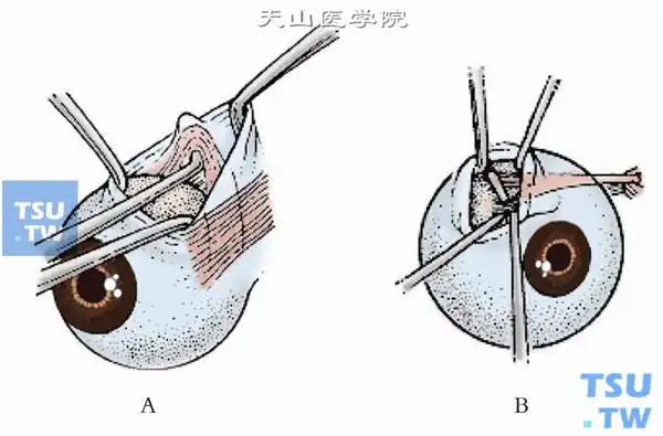 斜视haradoito术上斜肌矢状移位术