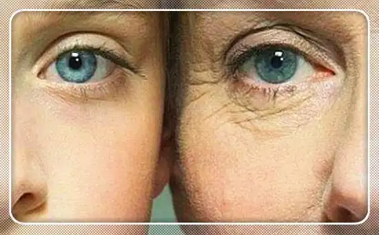 30岁的女人皱纹爬满眼角不想别人说你老20岁就得用眼霜