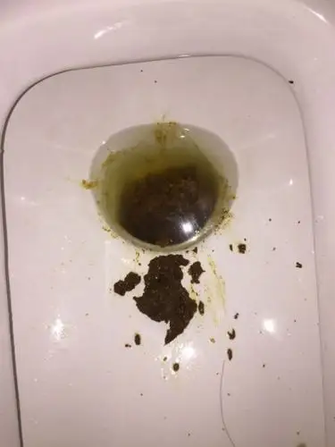 肠癌拉出来的大便是这种吗?