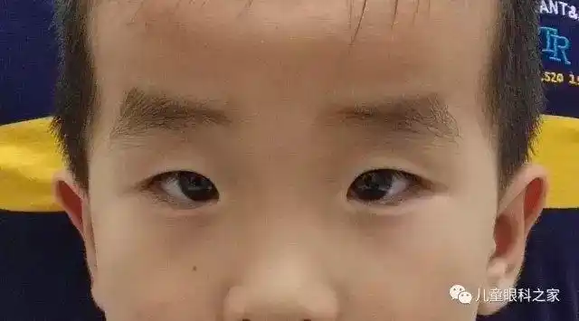 亲戚邻居朋友都说我家宝宝是斗鸡眼