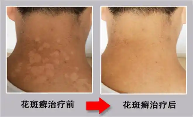北京花斑癣医院_北京治疗花斑癣哪家医院好_北京治疗花斑癣权威的医院