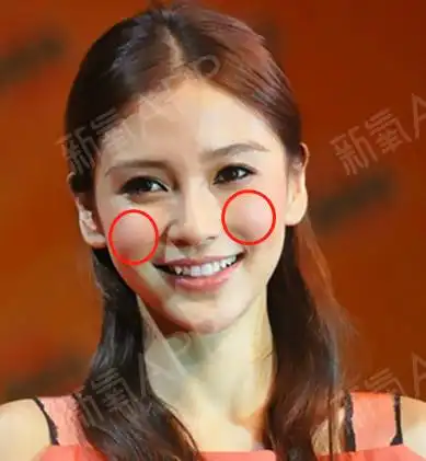 苹果肌凹陷主要是由先天性遗传或者后天衰老造成苹果肌变小