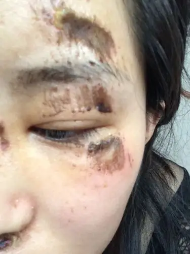 从电动车上摔下来 直接脸摔地下了 结疤了 以后会有明显的疤痕吗