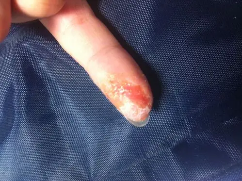 男13岁山东青岛病情描述(发病时间,主要症状等):每年秋初,他的手指