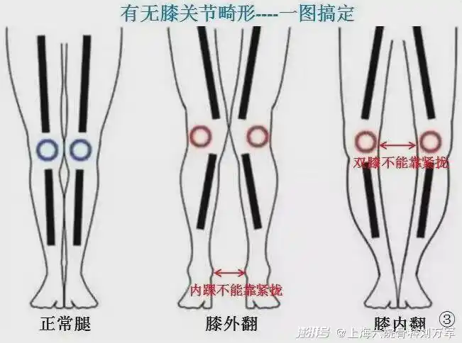 靠拢,双膝关节外翻畸形一般叫做x型腿,单膝外翻畸形一般也称为k型腿