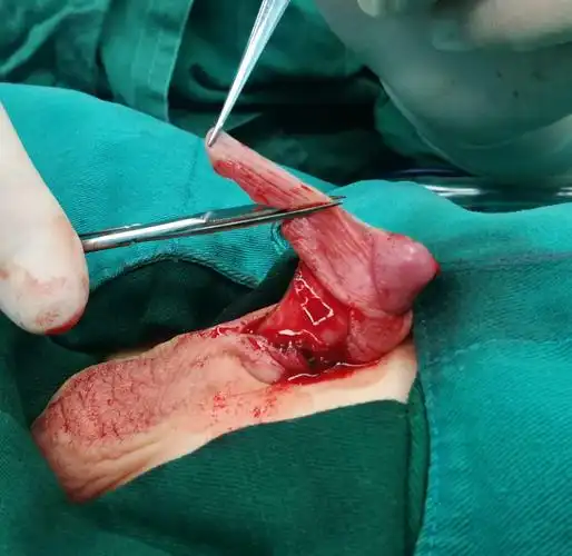 隐匿阴茎矫形术(f法)