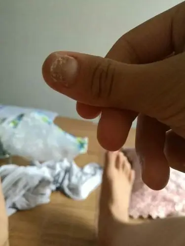 上次被肯德基的门夹了,我的指甲甲床是不是坏了.