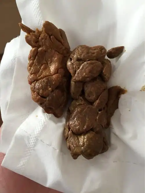 宝宝严重腹泻去医院输液,吃腹泻奶粉,现在不拉了大便像羊粪蛋一样