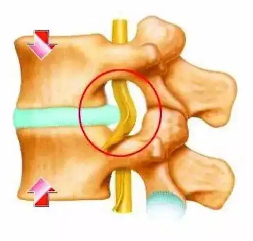 颈椎间盘突出,"按一下"就能回去?