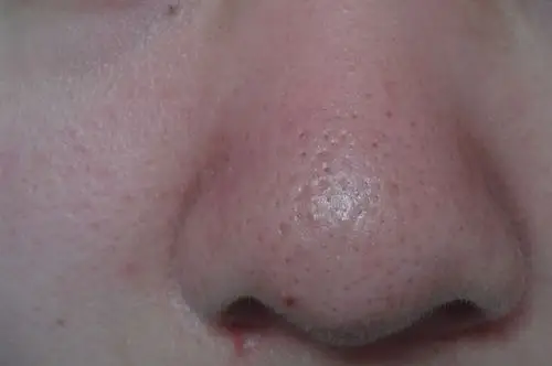 鼻子上毛孔大有黑头 什么方法比较有效呢_百度知道