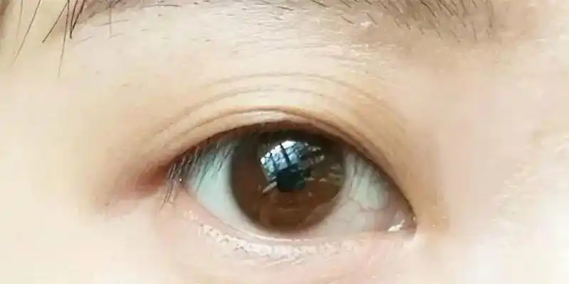 什么是眼皮松弛/下垂