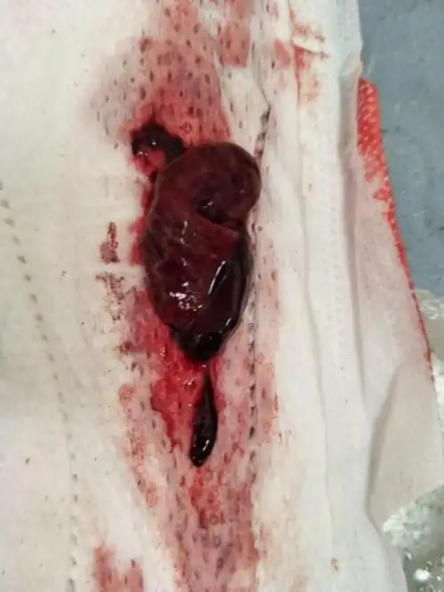 表示有血瘀的症状,最好提早做活血化瘀的治疗,避免瘀滞严重,影响月经