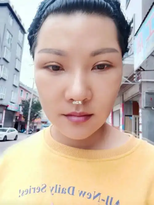 拉皮手术二十天和一个月了的照片_拉皮_皮肤问题_疤痕_双眼皮_美妆_医