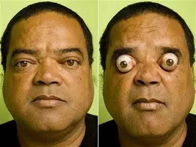 有个吉尼斯记录是比眼球突出的