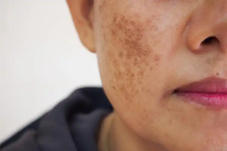 明显刺激皮肤中的黑色素细胞,促进黑色素的合成,从而导致脸上出现黑斑