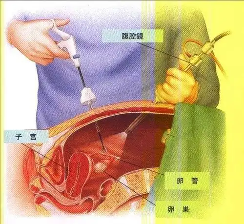 做了结扎,后悔还来得及吗?收好这个怀孕"姿势",男女都要知道