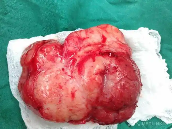 巨大乳腺纤维腺瘤1例-医联