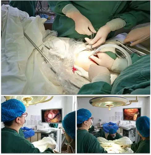 独立完成首例腹腔镜下全子宫切除 右侧巧克力囊肿剔除术