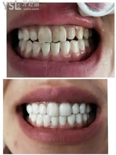 树脂贴面对比图