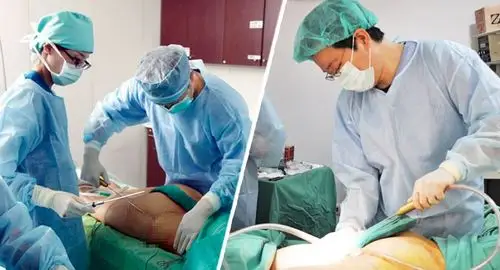 香港女商人在台做抽脂手术猝死,抽脂手术等同于减肥?