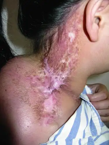 皮肤性病科图谱物理性皮肤病放射性皮炎