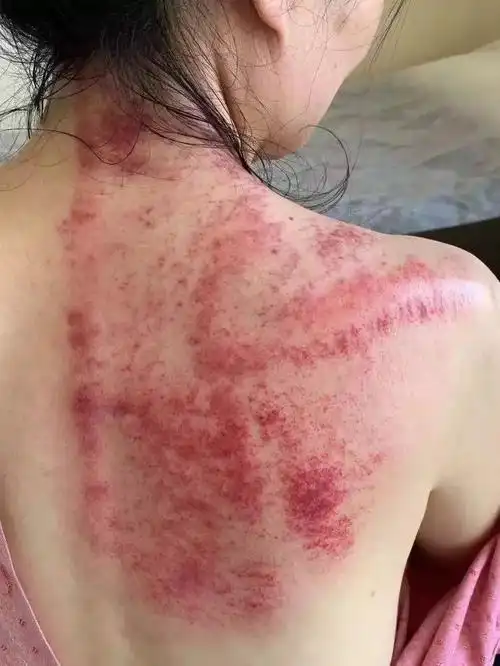 一次搞定肩背疼痛,动动手你也可以_刮痧